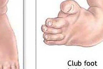 Mengenal Penyebab Kaki Pengkor (Clubfoot) pada Anak, Bisakah Sembuh tanpa Operasi?